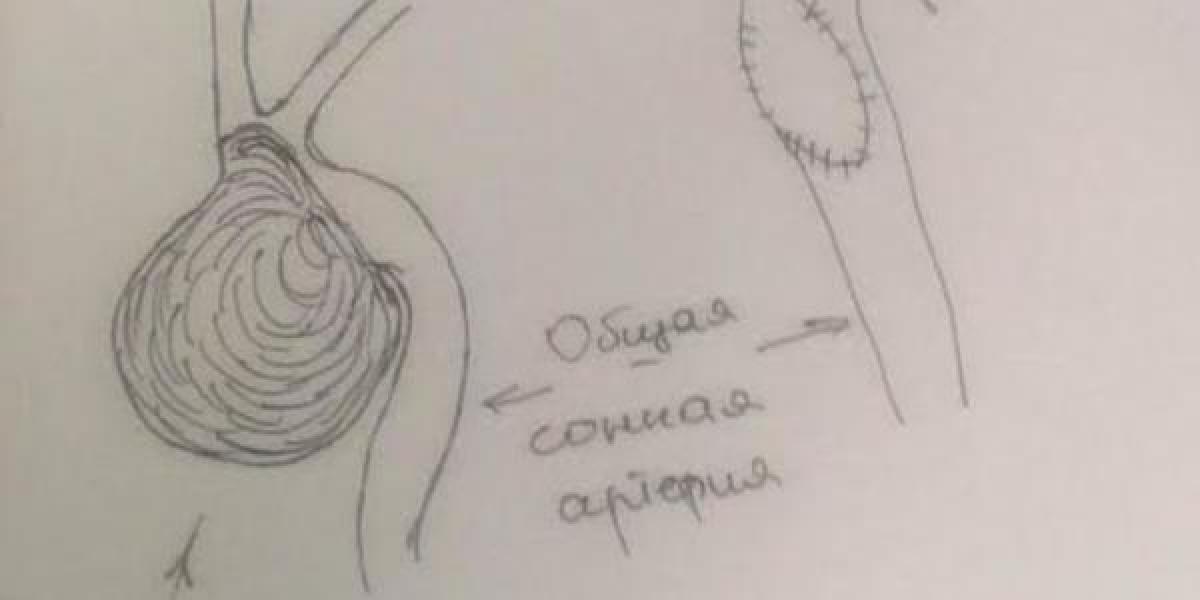 В Кременчуге впервые выполнена операция на сонной артерии